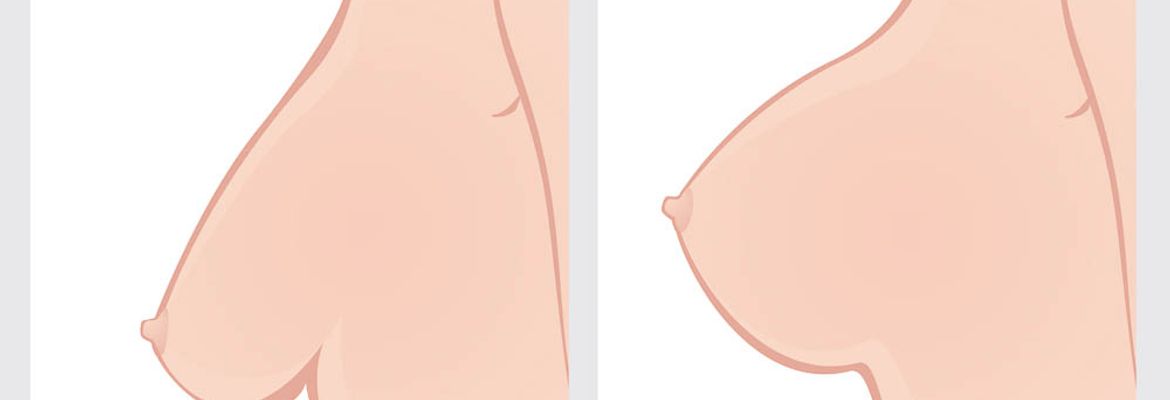 breast lift procedure in costa rica